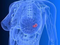 天水乳腺肿瘤的临床表